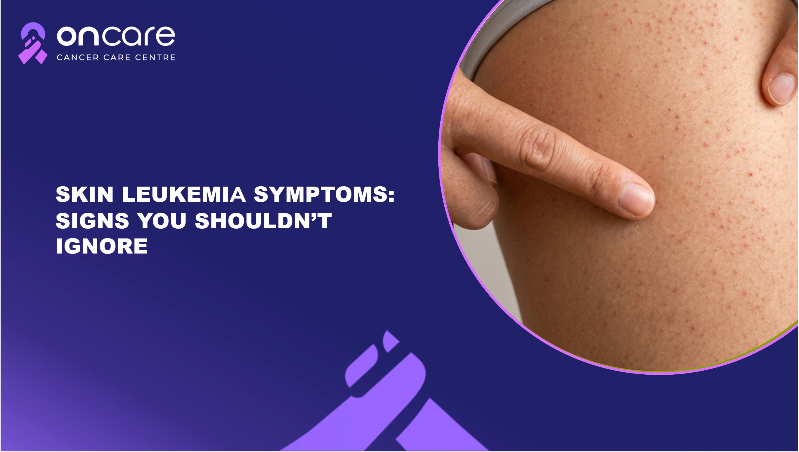 Leukemia Skin Symptoms | Oncare Cancer Hospital