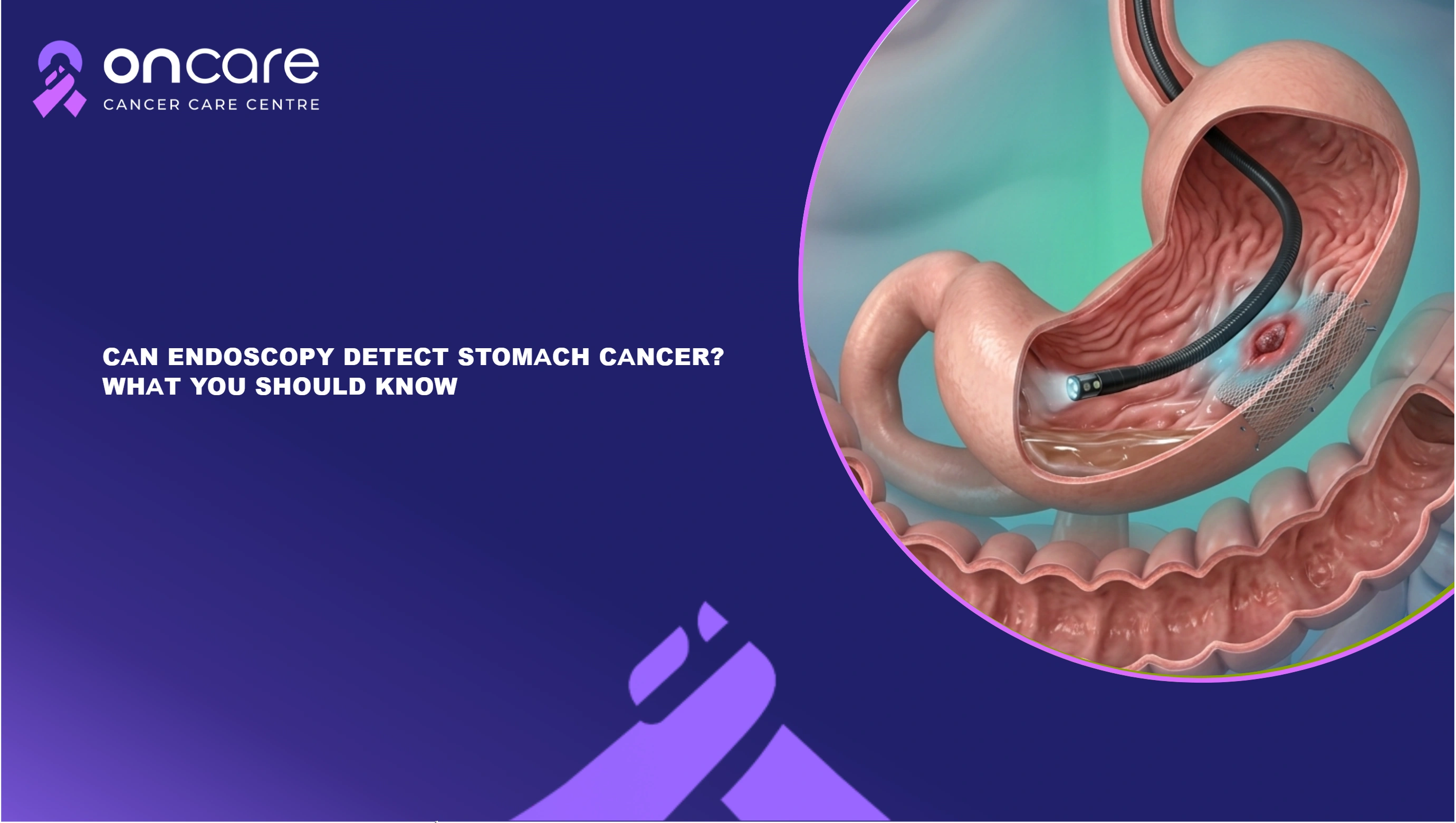 Can Endoscopy Detect Stomach Cancer? Symptoms & Accuracy