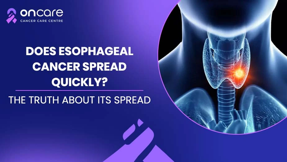 Does Esophageal Cancer Spread Fast? | Oncare Cancer Hospital