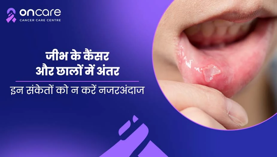 जीभ के कैंसर के शुरुआती लक्षण vs सामान्य छाले | Oncare