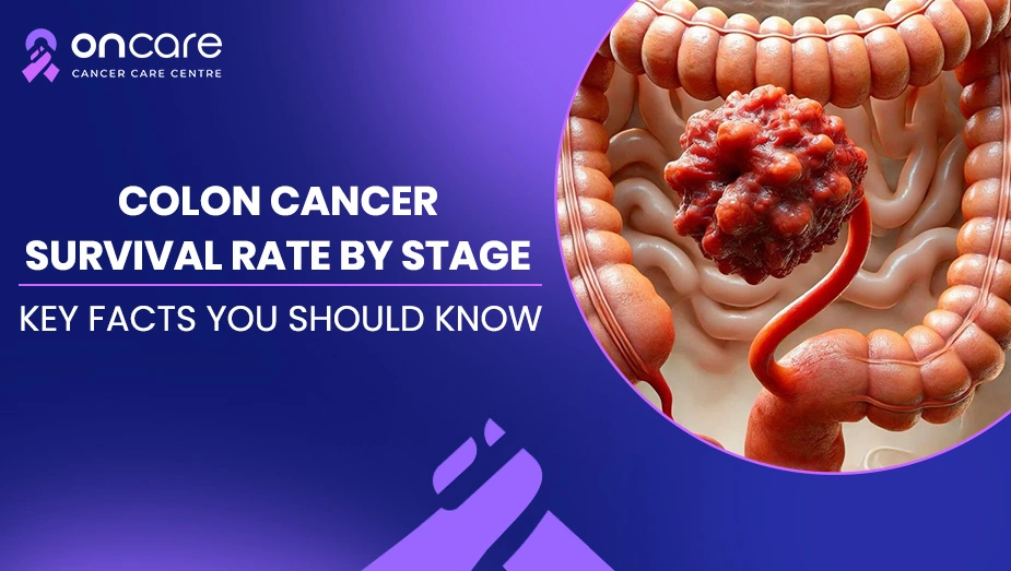 Colon Cancer Survival Rate by Stage: Why Early Detection Saves Lives