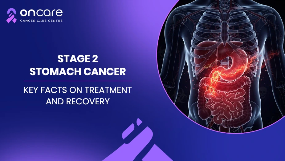 Stage 2 Stomach Cancer: Symptoms, Treatment, and Recovery Guide
