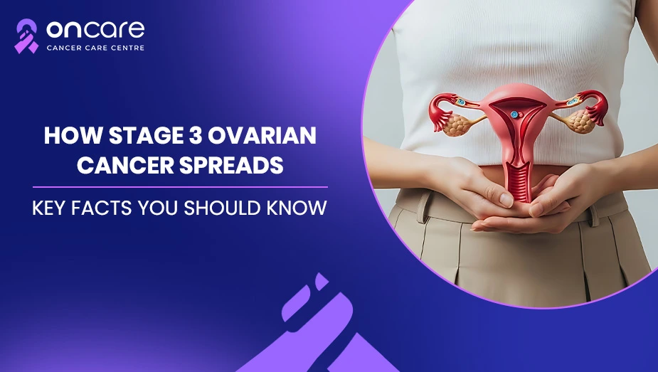 Stage 3 Ovarian Cancer: How It Spreads and What It Means