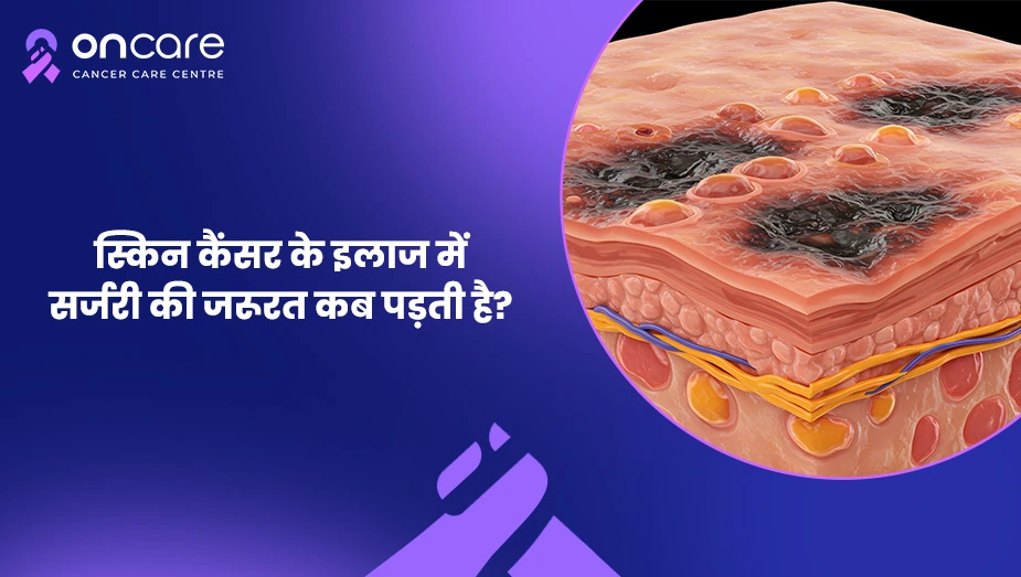 स्किन कैंसर में सर्जरी कब जरूरी होती है? | Oncare Hospital