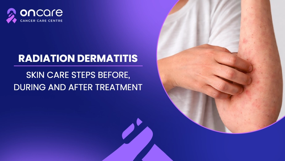 radiation dermatitis treatment