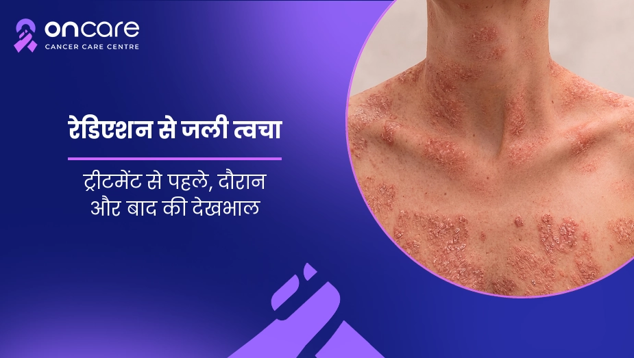 रेडिएशन से जली त्वचा