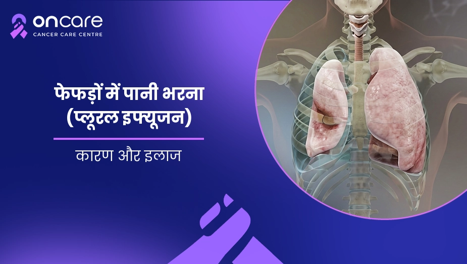 फेफड़ों में पानी भरना (प्लूरल इफ्यूजन)