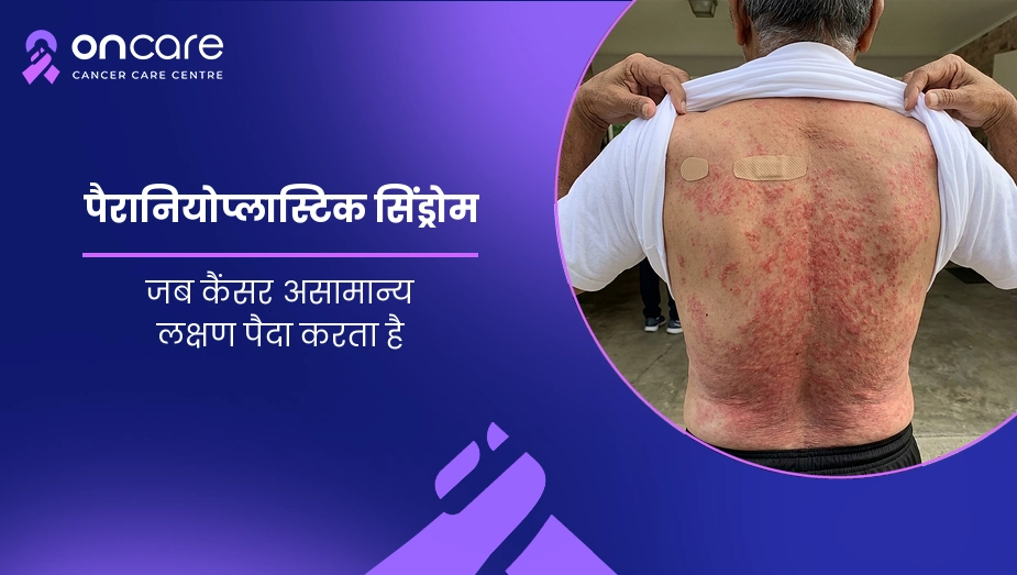 पैरानियोप्लास्टिक सिंड्रोम