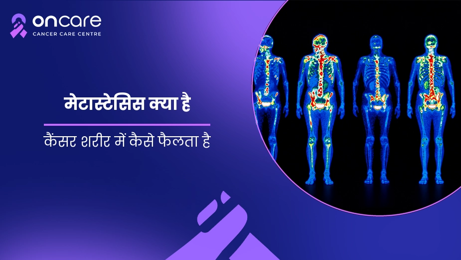मेटास्टेसिस क्या है