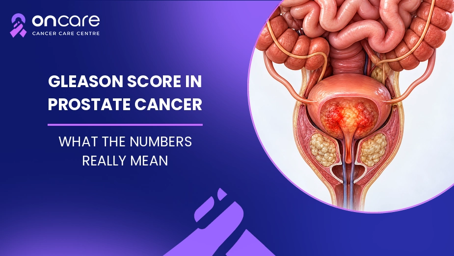 Gleason Score in Prostate Cancer
