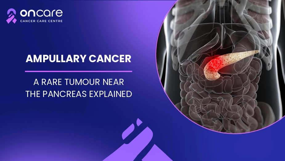 ampullary cancer