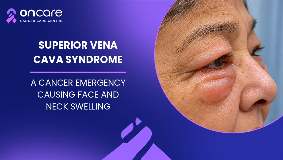 Superior Vena Cava Syndrome