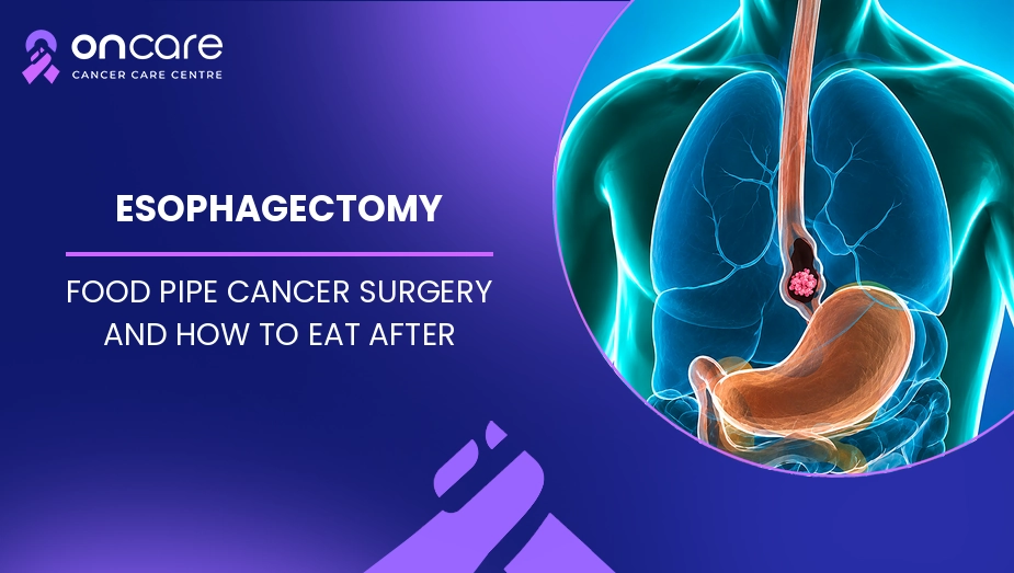 esophagectomy surgery