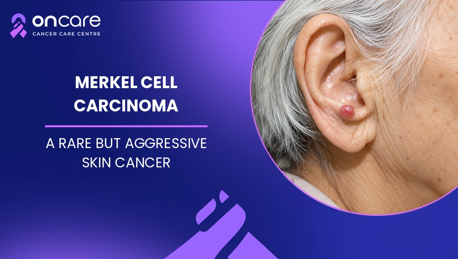 Merkel Cell Carcinoma
