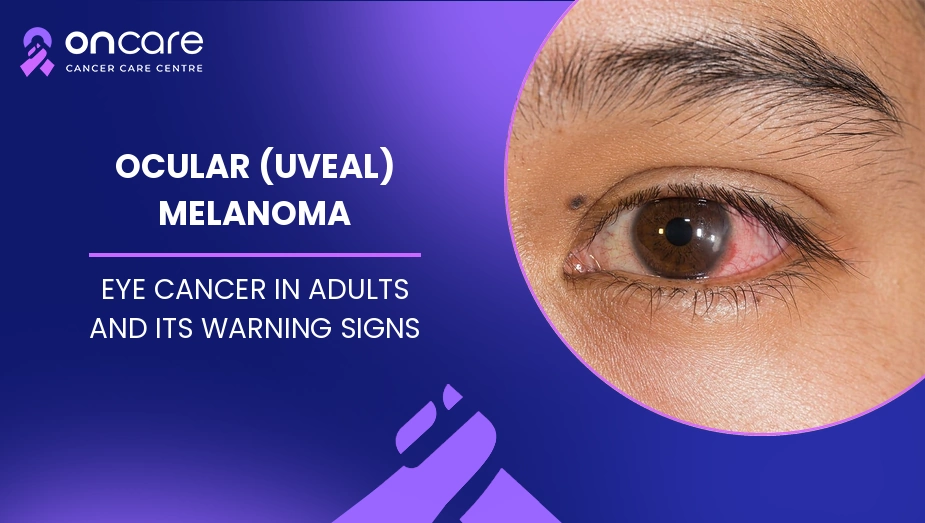 ocular melanoma
