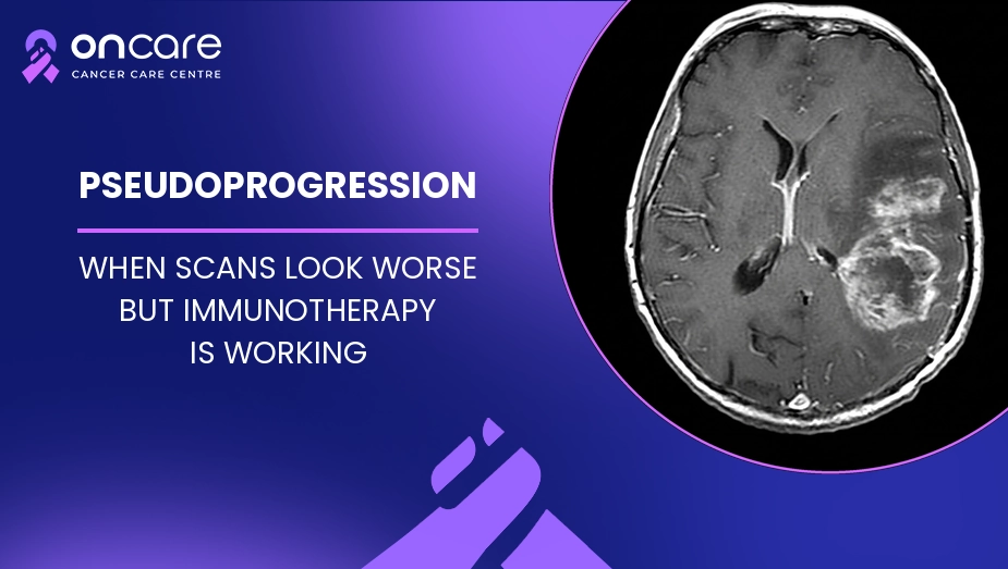 pseudoprogression immunotherapy