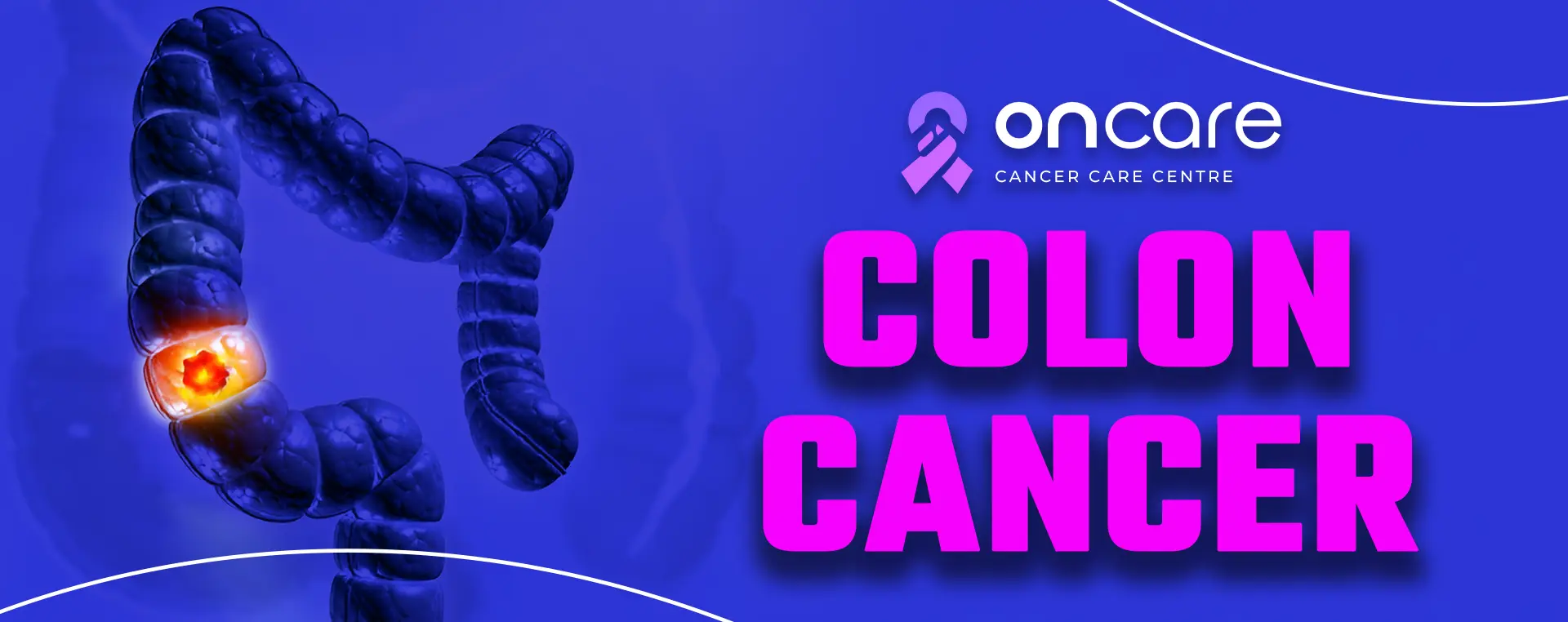 Colon Cancer