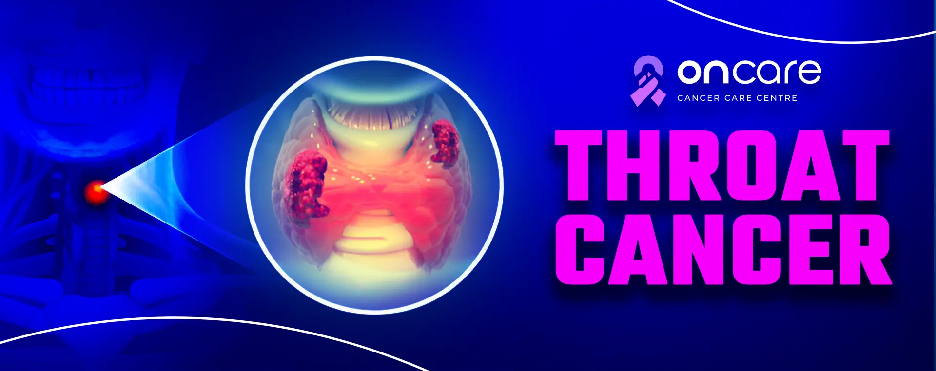 Throat Cancer