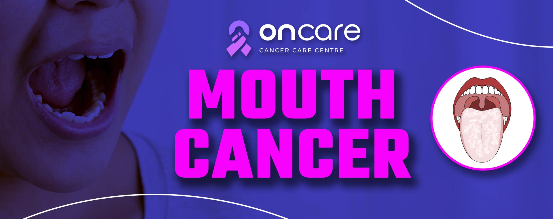 Mouth Cancer