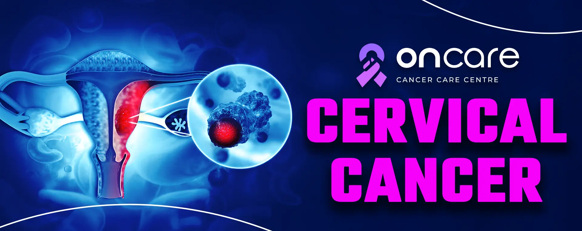 Cervical Cancer