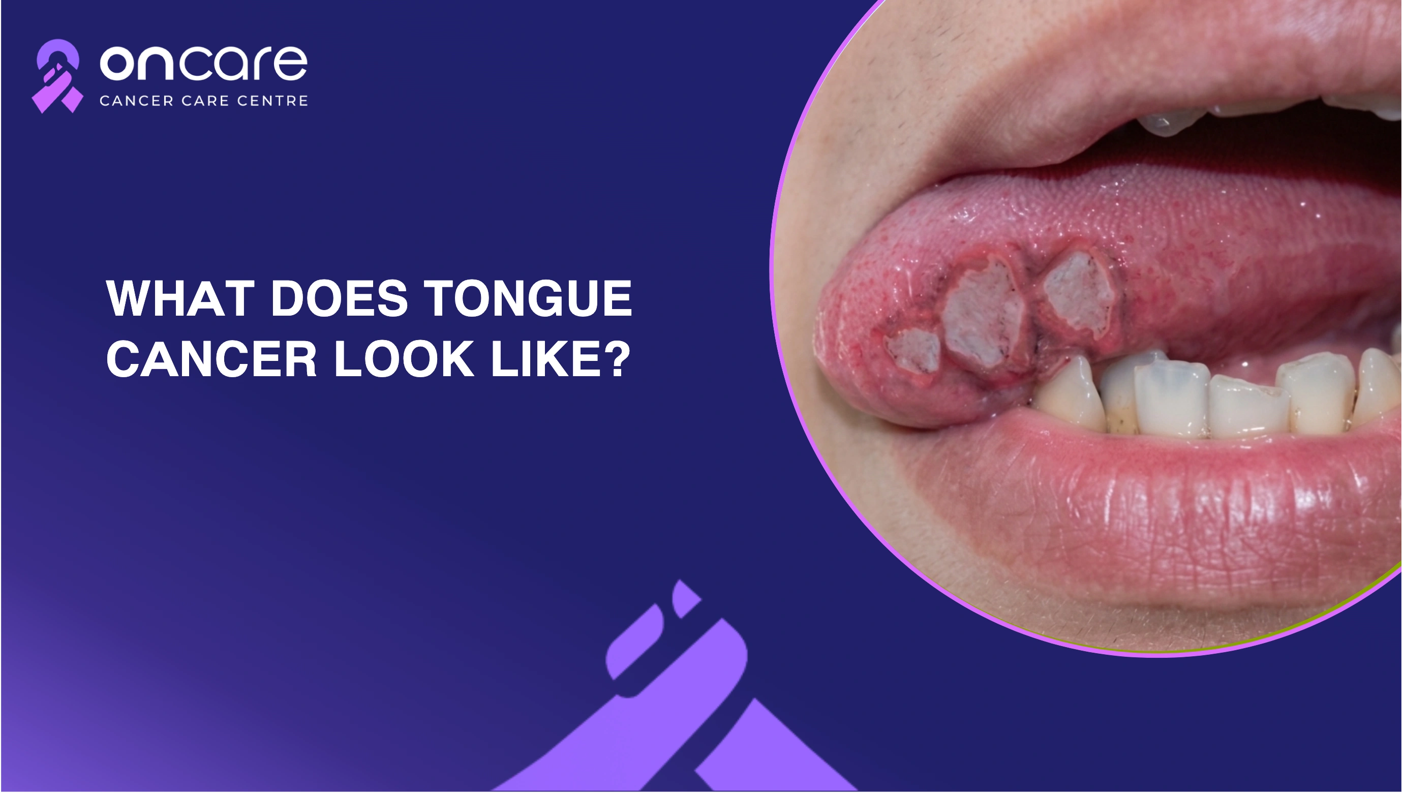 10 common tongue cancer symptoms you shouldn’t ignore?