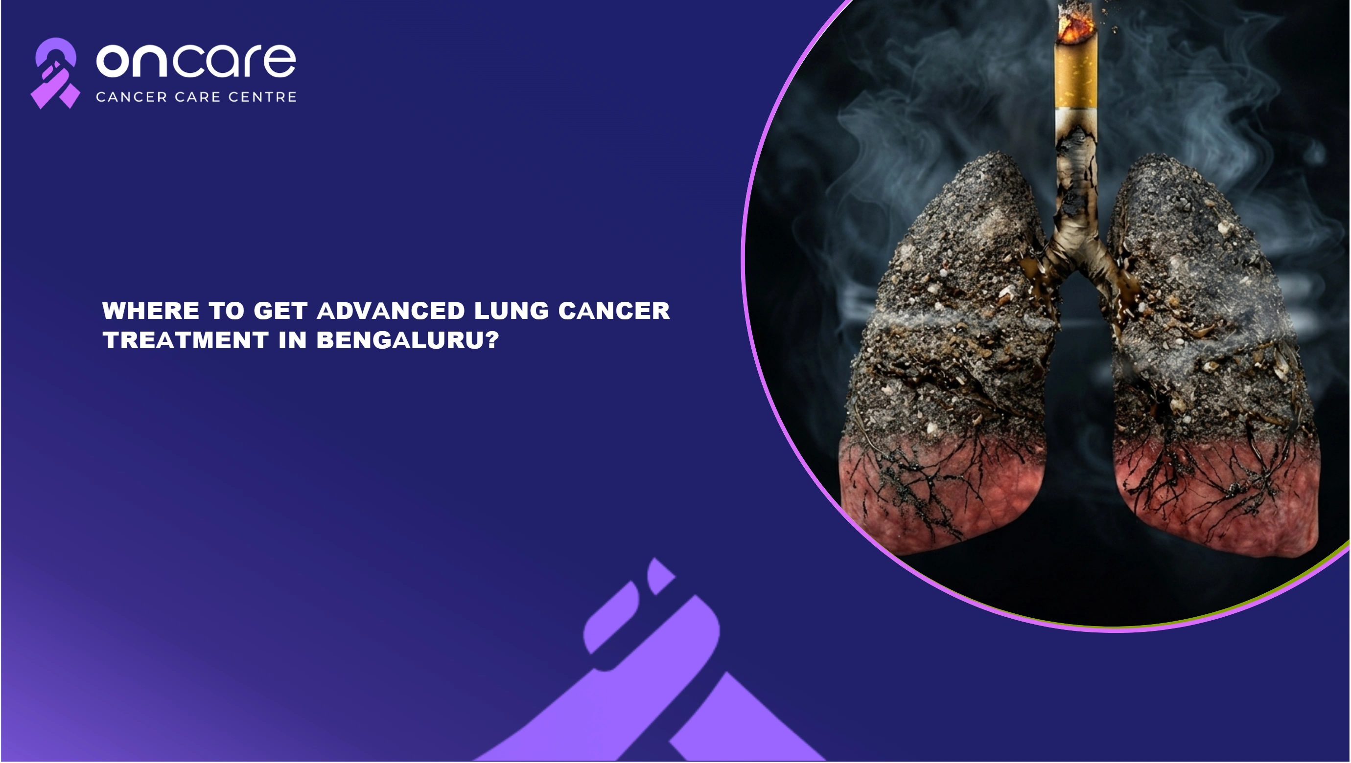Radiation Therapy in Bengaluru | Oncare Cancer Hospital
