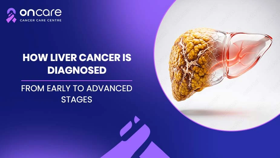 How Liver Cancer Is Diagnosed: From Early to Advanced Stages