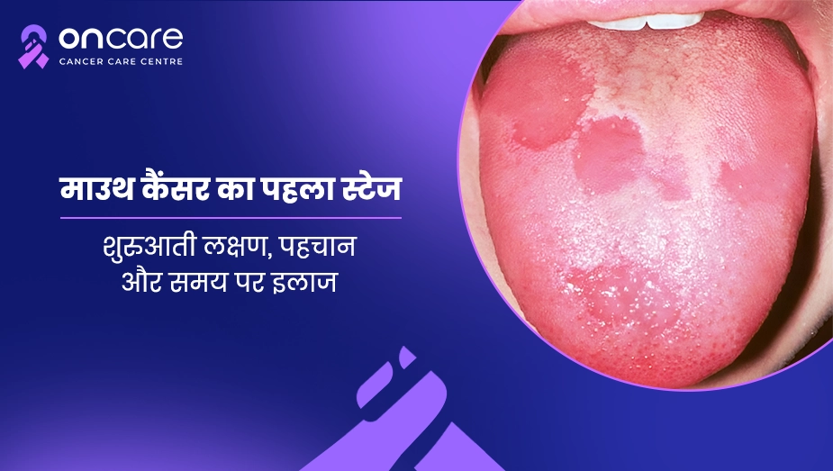 माउथ कैंसर का पहला स्टेज