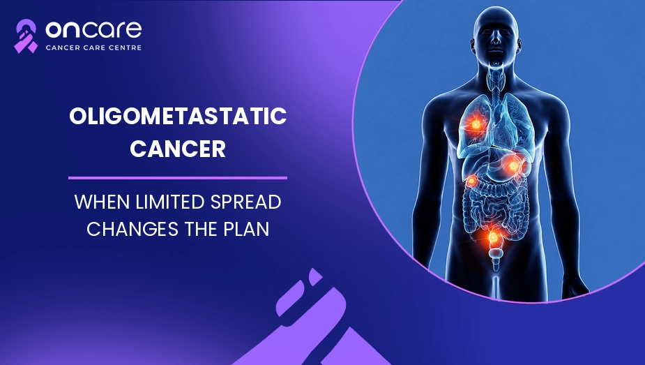 Oligometastatic Cancer