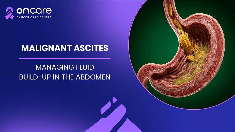 Malignant Ascites