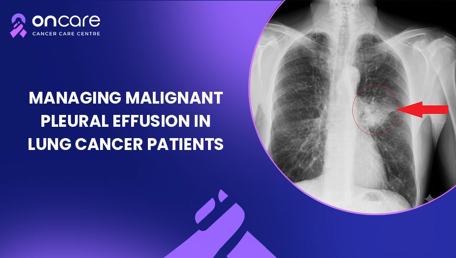 Managing Malignant Pleural Effusion