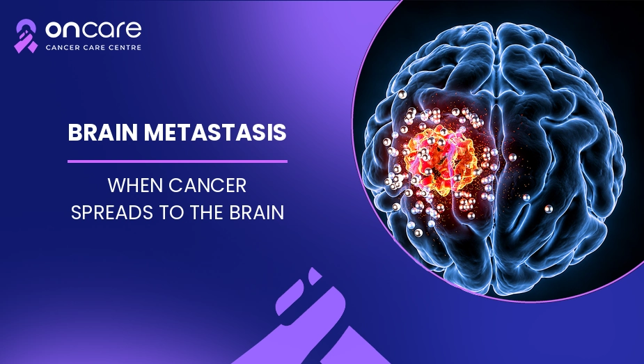 Brain Metastasis