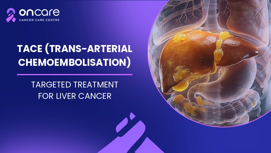 TACE (Trans-Arterial Chemoembolisation)