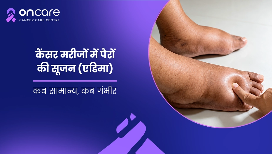 कैंसर मरीजों में पैरों की सूजन