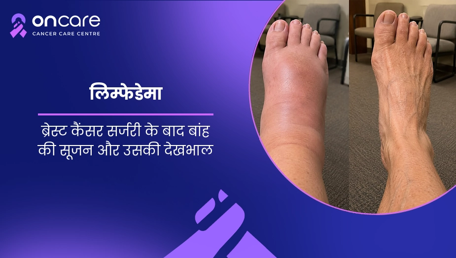लिम्फेडेमा